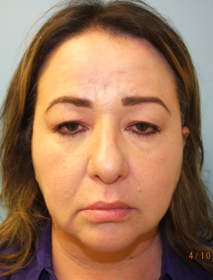 Blepharoplasty Before & After Patient #13624