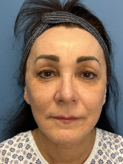 Browlift Before & After Patient #13634