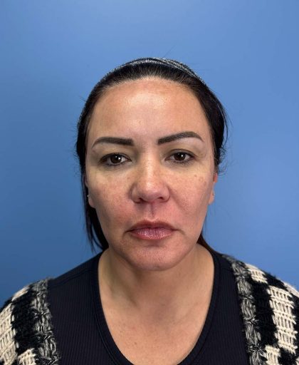 Browlift Before & After Patient #13677