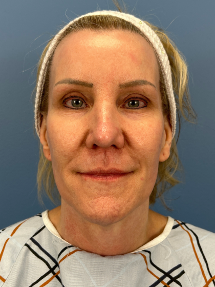 Facelift and Necklift Before & After Patient #13656