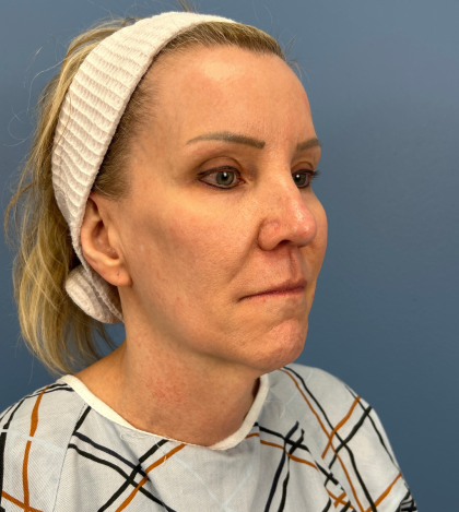 Facelift and Necklift Before & After Patient #13656