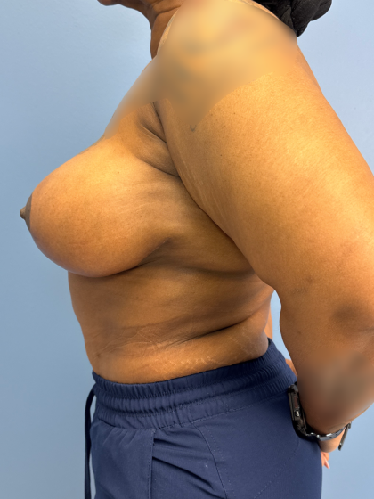 Breast Lift/Mastopexy Before & After Patient #13644
