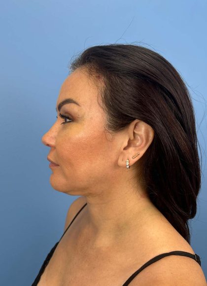 Browlift Before & After Patient #13677