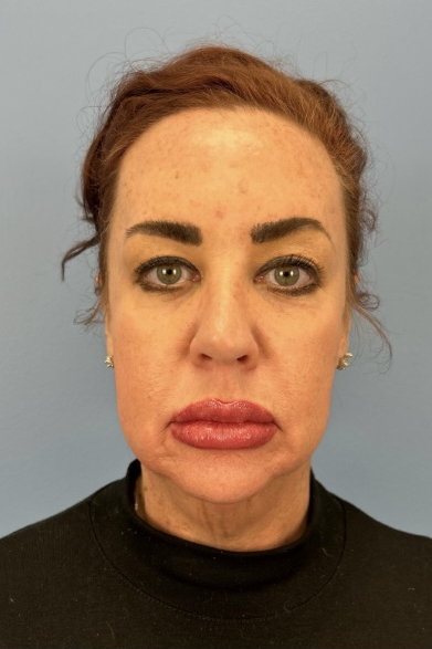 Facial Fat Grafting Before & After Patient #13568