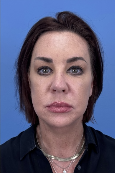 Facial Fat Grafting Before & After Patient #13568