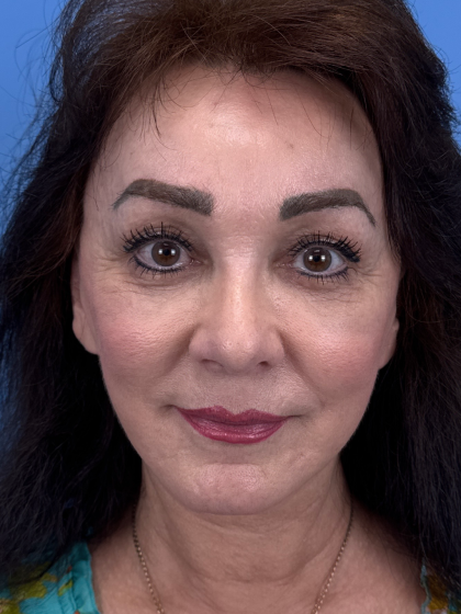 Browlift Before & After Patient #13634