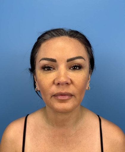 Browlift Before & After Patient #13677