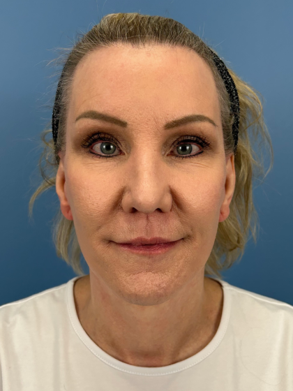 Facelift and Necklift Before & After Patient #13656