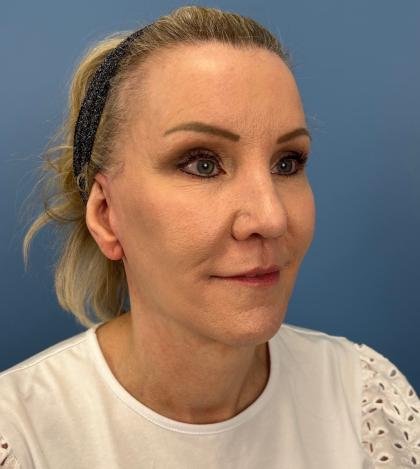 Facelift and Necklift Before & After Patient #13656