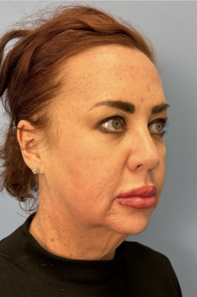 Facial Fat Grafting Before & After Patient #13568