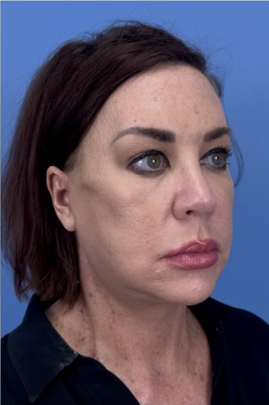 Facial Fat Grafting Before & After Patient #13568