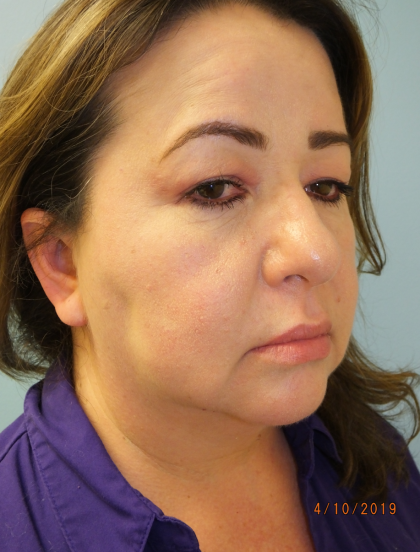 Blepharoplasty Before & After Patient #13624