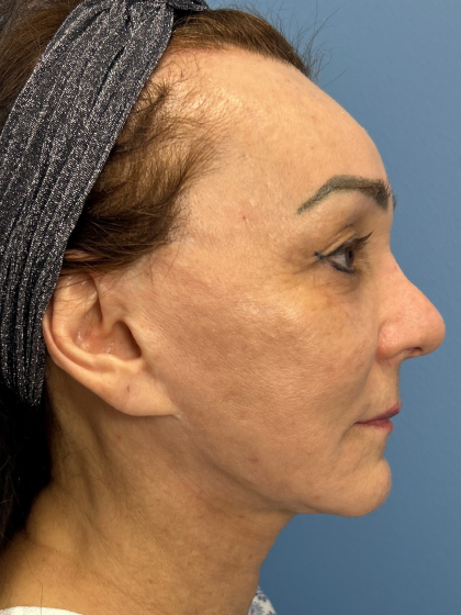 Browlift Before & After Patient #13634