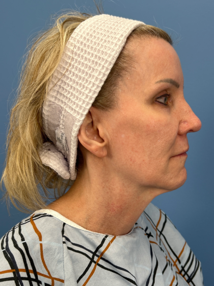 Facelift and Necklift Before & After Patient #13656