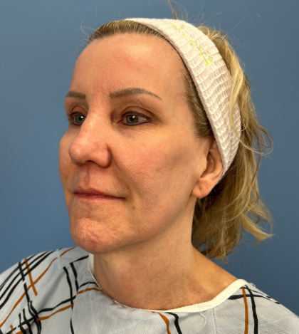 Facelift and Necklift Before & After Patient #13656