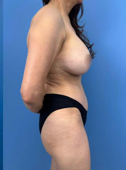 Tummy Tuck Before & After Patient #13692