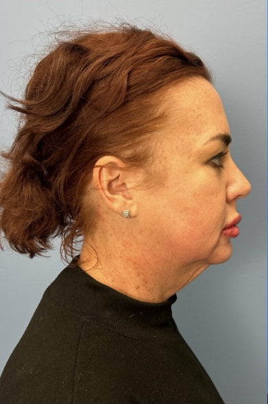 Facial Fat Grafting Before & After Patient #13568