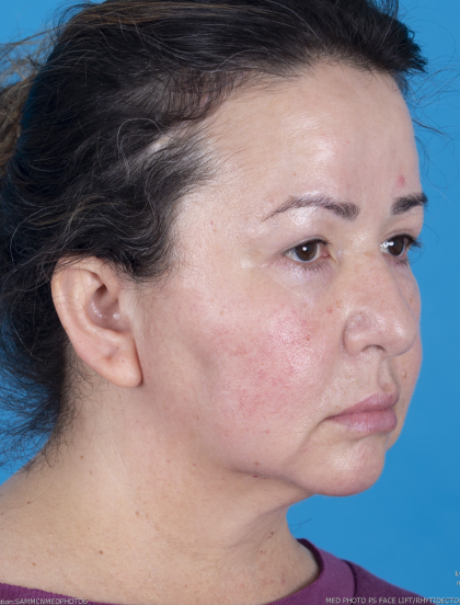 Blepharoplasty Before & After Patient #13624