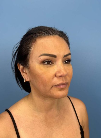 Browlift Before & After Patient #13677