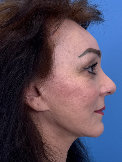 Browlift Before & After Patient #13634