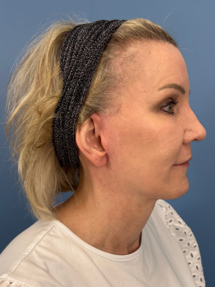 Facelift and Necklift Before & After Patient #13656