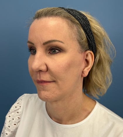 Facelift and Necklift Before & After Patient #13656