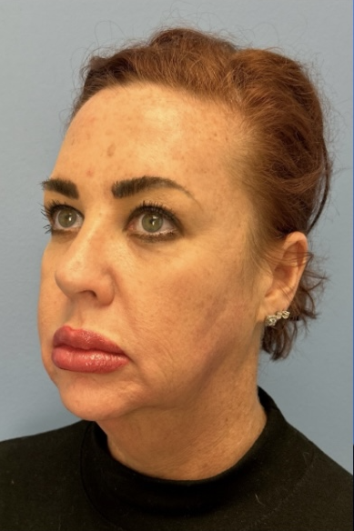 Facial Fat Grafting Before & After Patient #13568