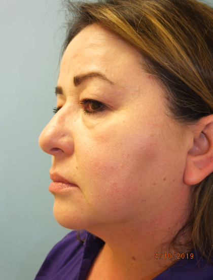 Blepharoplasty Before & After Patient #13624