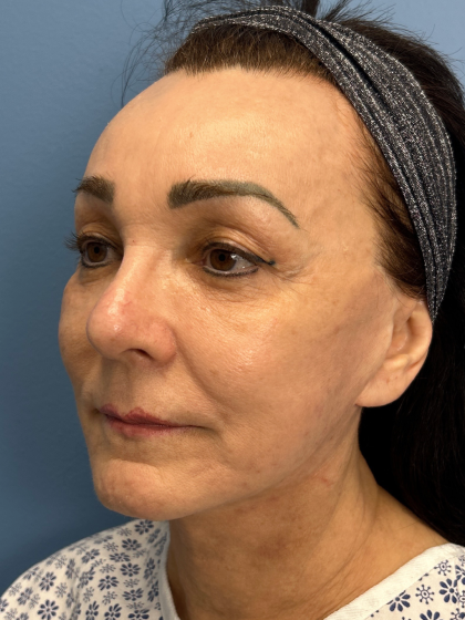 Browlift Before & After Patient #13634