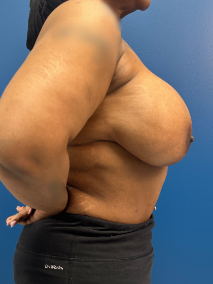 Breast Lift/Mastopexy Before & After Patient #13644