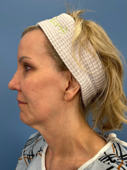 Facelift and Necklift Before & After Patient #13656