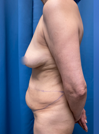 Tummy Tuck Before & After Patient #13692