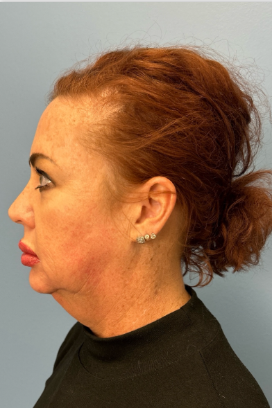 Facial Fat Grafting Before & After Patient #13568
