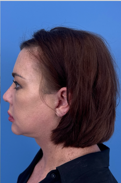 Facial Fat Grafting Before & After Patient #13568