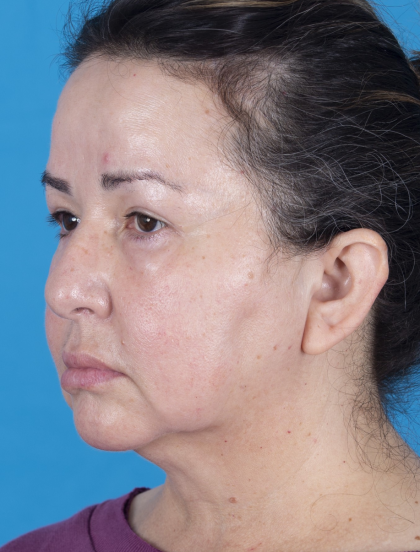 Blepharoplasty Before & After Patient #13624