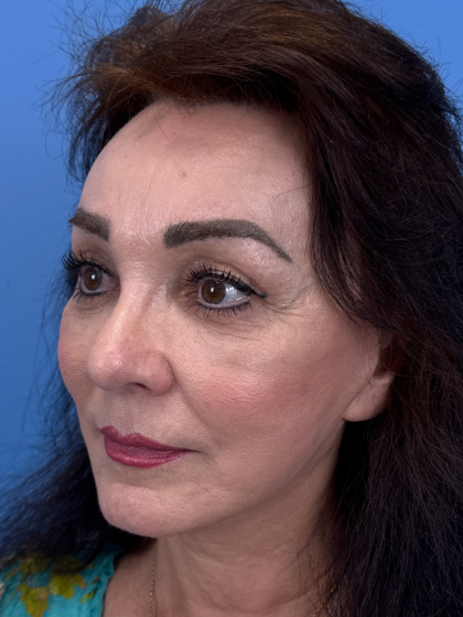 Browlift Before & After Patient #13634