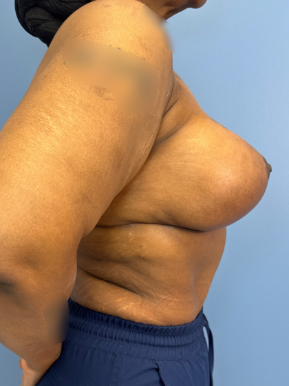 Breast Lift/Mastopexy Before & After Patient #13644