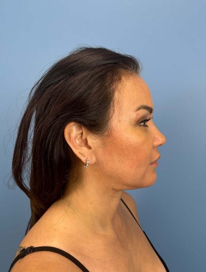 Browlift Before & After Patient #13677