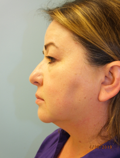 Blepharoplasty Before & After Patient #13624