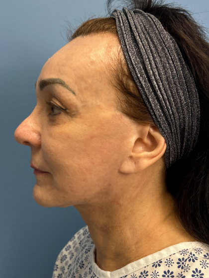 Browlift Before & After Patient #13634