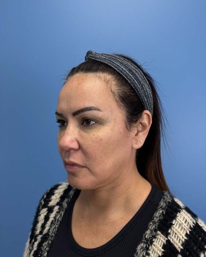 Browlift Before & After Patient #13677