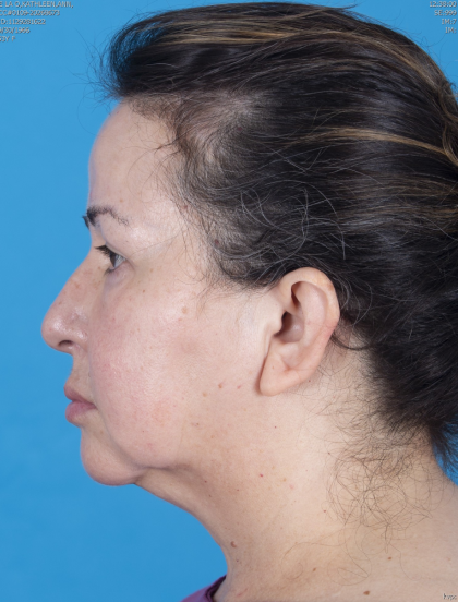 Blepharoplasty Before & After Patient #13624