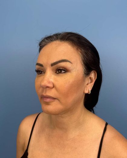 Browlift Before & After Patient #13677
