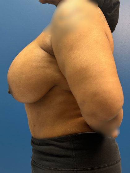 Breast Lift/Mastopexy Before & After Patient #13644