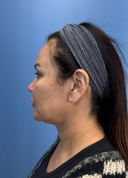 Browlift Before & After Patient #13677
