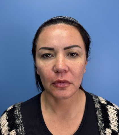 Browlift Before & After Patient #13913