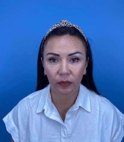 Browlift Before & After Patient #13913