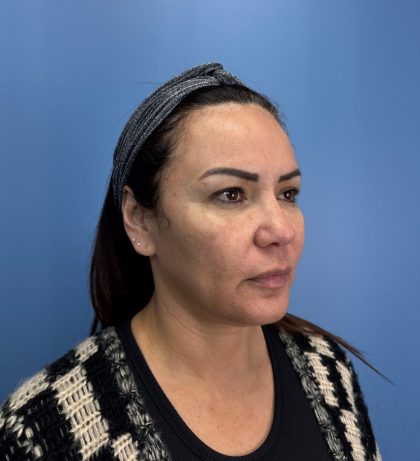 Browlift Before & After Patient #13913