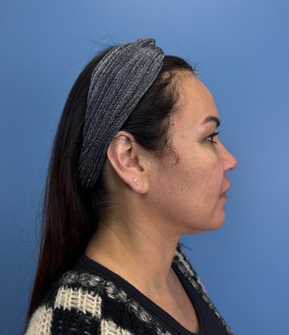 Browlift Before & After Patient #13913