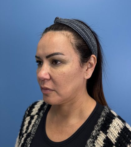 Browlift Before & After Patient #13913